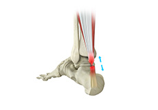 Achilles Tendon Rupture 