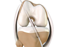 Anterior Cruciate Ligament (ACL) Reconstruction 