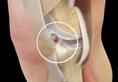 ACL Tears 