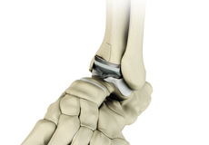 Ankle joint Replacement 