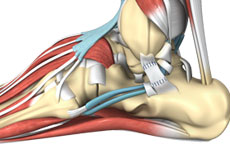 Ankle Sprain 