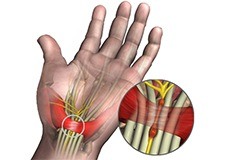 Carpal tunnel syndrome 