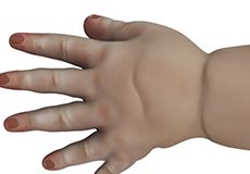 Congenital Hand Deformities 