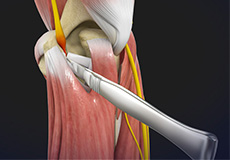 Endoscopic Cubital Tunnel Release 