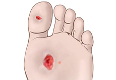 Diabetic Foot and Chronic Wounds