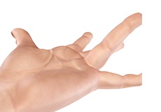 Dupuytren’s contracture