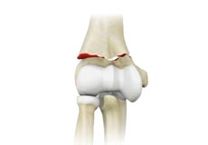 Elbow Fractures 