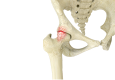 Femoroacetabular Impingement (FAI) 