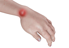 Ganglion Cyst