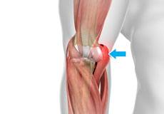 Golfer's Elbow 