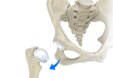 Hip Dislocation 