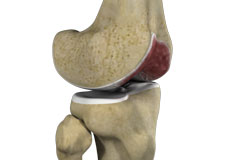 Knee Arthritis 