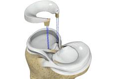 Meniscal Transplants 