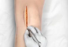 Minimally Invasive Total Knee Replacement 