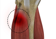 Muscle Strains in the Thigh