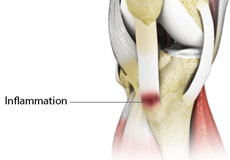 Osgood-Schlatter Disease