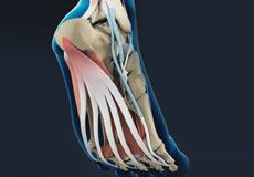 Plantar Fasciitis