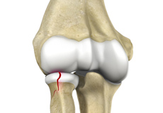 Radial Head Fractures