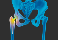 Revision Hip Replacement 