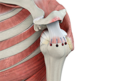 Rotator Cuff Repair  