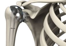 Shoulder Joint Replacement 