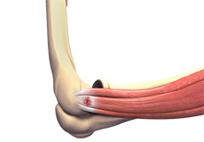 Tennis Elbow 