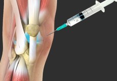 Viscosupplementation Treatment for Arthritis 