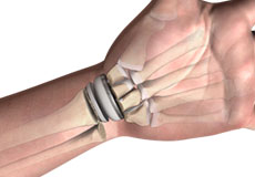 Wrist Joint Replacement 